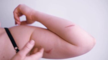 Sağlıksız genç bir kadının yakın plan cilt sorunları, dayanılmaz bir acı ve rahatsızlık hisseder. Yaralı deri kavramı. Dermatoloji, tıbbi tedavi ile cilt bakımı