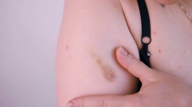 Sağlıksız genç bir kadının yakın plan cilt sorunları, dayanılmaz bir acı ve rahatsızlık hisseder. Yaralı deri kavramı. Dermatoloji, tıbbi tedavi ile cilt bakımı