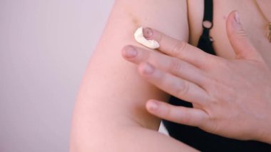 Kafkasyalı genç bir kadının sıcak yağ dökülmesi ya da yangının yol açtığı birinci derece yanık yarasını iyileştirmek için yara giderici krem sürmesine yakın durun. sorunlu cildin sağlık, bakım ve tedavisinden başka