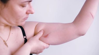 Sağlıksız genç bir kadının yakın plan cilt sorunları, dayanılmaz bir acı ve rahatsızlık hisseder. Yaralı deri kavramı. Dermatoloji, tıbbi tedavi ile cilt bakımı