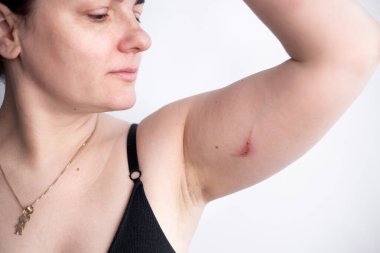 Sağlıksız genç bir kadının yakın plan cilt sorunları, dayanılmaz bir acı ve rahatsızlık hisseder. Yaralı deri kavramı. Dermatoloji, tıbbi tedavi ile cilt bakımı