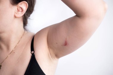 Sağlıksız genç bir kadının yakın plan cilt sorunları, dayanılmaz bir acı ve rahatsızlık hisseder. Yaralı deri kavramı. Dermatoloji, tıbbi tedavi ile cilt bakımı