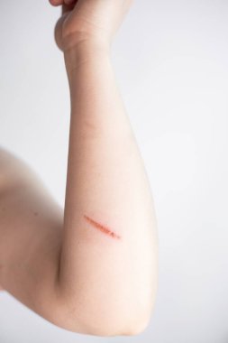 Sağlıksız genç bir kadının yakın plan cilt sorunları, dayanılmaz bir acı ve rahatsızlık hisseder. Yaralı deri kavramı. Dermatoloji, tıbbi tedavi ile cilt bakımı