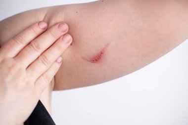 Sağlıksız genç bir kadının yakın plan cilt sorunları, dayanılmaz bir acı ve rahatsızlık hisseder. Yaralı deri kavramı. Dermatoloji, tıbbi tedavi ile cilt bakımı