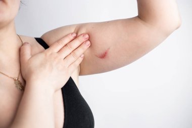 Sağlıksız genç bir kadının yakın plan cilt sorunları, dayanılmaz bir acı ve rahatsızlık hisseder. Yaralı deri kavramı. Dermatoloji, tıbbi tedavi ile cilt bakımı