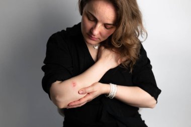 Derisinde termal yanık olan bir kadın eli. Ütü yaparken ya da yemek pişirirken aile içi yaralanma. Elin kadınındaki yaralar..