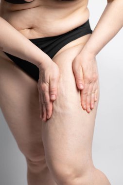 Kadın, selülit ve deri altı yağlarını kontrol etmek için bacaklarına deri sıkıştırıyor. Kalçasındaki çatlakları gösteren bir kadın. Cildinde gerilme izleri olan kadın kalçaları..