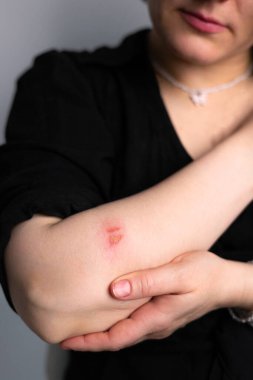 Derisinde termal yanık olan bir kadın eli. Ütü yaparken ya da yemek pişirirken aile içi yaralanma. Elin kadınındaki yaralar..