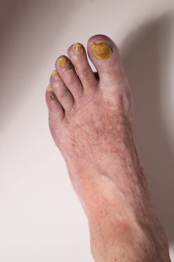 Mantar yüzünden tırnakları zarar görmüş yaşlı bir kadının ayağı. Kadınların bacaklarındaki varis damarları.