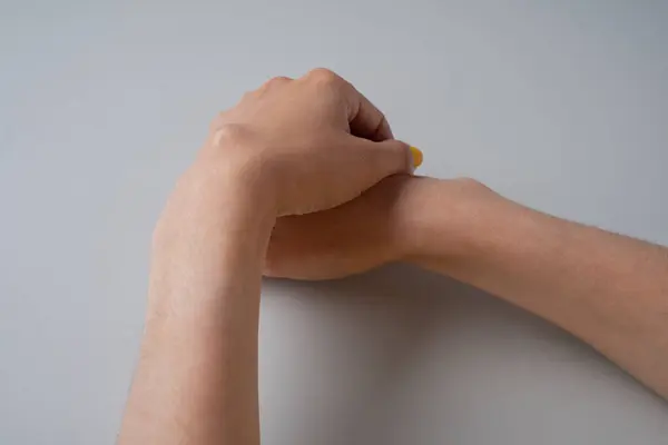 stock image Ganglion cyst on woman hand on white background