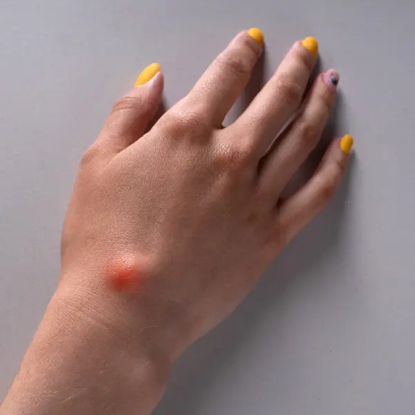 stock image Ganglion cyst on woman hand on white background