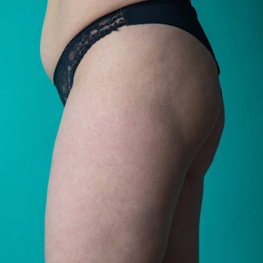 Kadın mide ve bacakları selülit izleriyle kaplı.