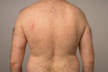 Alerji reaksiyonu genç bir adamın vücudundaki kırmızı noktalardır. Ürtiker