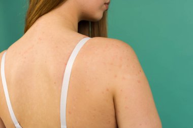 Otoimmün, çaresi olmayan sedef hastalığı olan, sedef hastalığı olan genç bir kadın. Kırmızı, iltihaplı, dirseklerinde pullu kızarıklık. Sedef iltihabı.