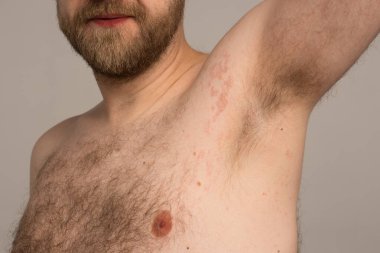 Alerji reaksiyonu genç bir adamın vücudundaki kırmızı noktalardır. Ürtiker