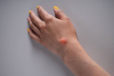 Ganglion kisti beyaz arka planda kadın eli üzerinde