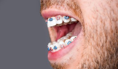 Dişleri dengelemek için insanın beyaz dişlerindeki diş tellerine yakın. Gülümseyen ağızda bilezik sistemi, makro fotoğraf dişleri, yakın plan dudaklar, makro çekim, dişçi. Diş telli adam..