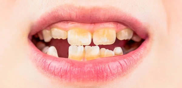 Dětská Pacientka Otevřenými Ústy Vykazující Zubní Kaz Dítě Usměje Ukáže — Stock fotografie