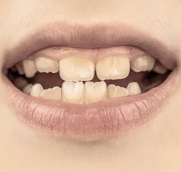 Κακό Παιδί Δόντια Πορτρέτο Χαλασμένα Δόντια Κοντινό Πλάνο Ανθυγιεινών Δοντιών — Φωτογραφία Αρχείου