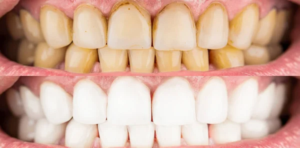 特写人在白化前后的牙齿 美白前后的男性牙齿 口腔科 口腔科 牙齿美白前后的微笑男人 — 图库照片