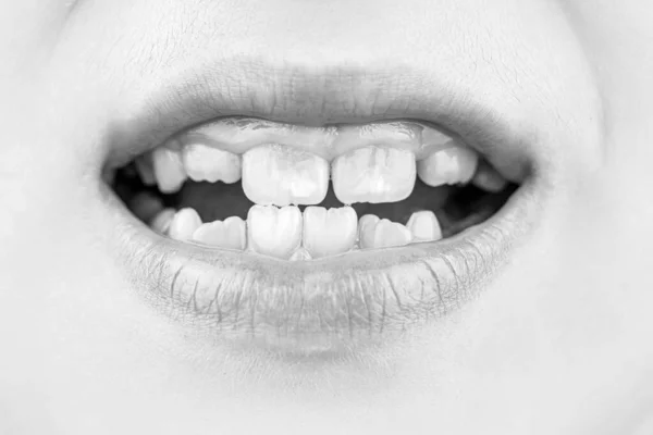 Špatné Zuby Dítě Portrétní Chlapec Špatnými Zuby Zblízka Nezdravé Dětské — Stock fotografie