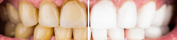 人在牙齿美白前后的过程 美白前后的男牙 口腔科 口腔科 — 图库照片