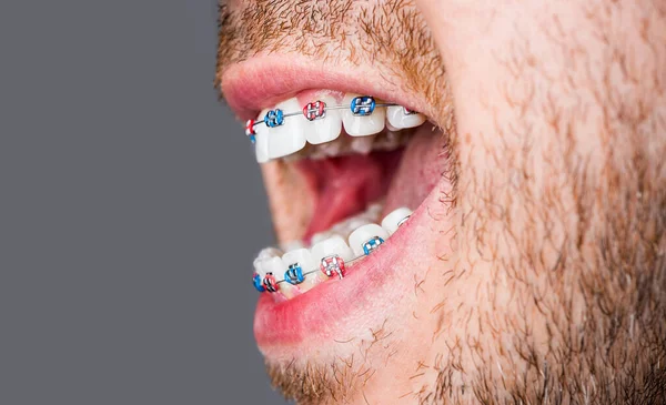 Bracket System Smiling Mouth Macro Photo Teeth Close Lips Macro — Stock Photo, Image