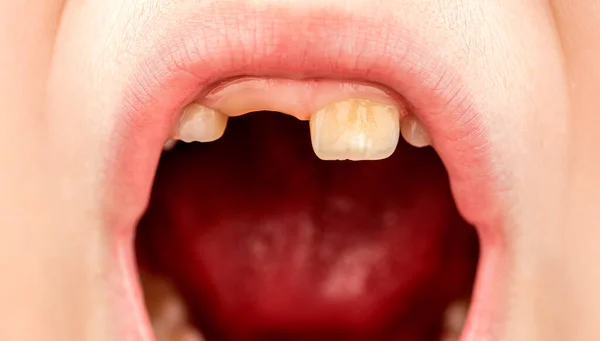 悪い歯の子 悪い歯の肖像画の少年 子供の笑顔と彼女の混雑歯を見る 不健康な赤ん坊の歯を閉じてください 虫歯を示す子供患者オープン口 — ストック写真