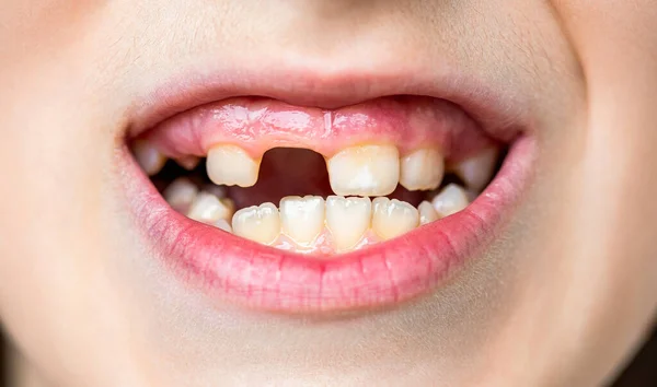 Child Bad Teeth Boy Kid Lost Front Tooth Toothache Child — Stock Photo, Image