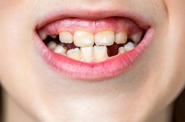 Teeth Yellow Teeth Bad Dental Health Teeth Fluoride Tooth Erosion — Stock Photo, Image