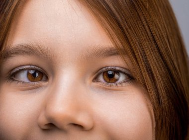 Küçük hasta strabismus, göz hastalıkları tedavisi. Strabismus 'lu kadın gözler. Hipertropia. Strabismus. Yakın plan çocuk yüzü, gözler kız..