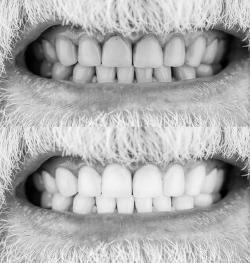 Male teeth before and after whitening, oral care dentistry, stomatology. Smiling man before and after teeth whitening procedure. Black and white. clipart