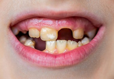 Sağlıksız bebek dişlerinin kapanışı. Çocuk dişini kaybettikten sonra diş etlerindeki boşluğu gösteriyor. Yaklaş, dişlerini kaybeden çocuk. Kötü dişli çocuk. Kötü dişli bir portre çocuğu..