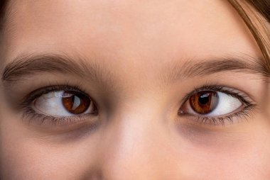 Strabismus, göz hastalıkları tedavisi. Strabismus 'lu kadın gözler. Hipertropia. Strabismus. Yakın plan çocuk yüzü, gözler kız..