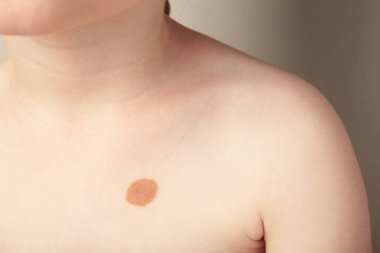 Büyük köstebek. Bir çocuğun vücudunda doğum lekesi. Üst görünüm