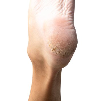 Erkek derisi kuru, topukları çatlamış, beyaz arka planda izole edilmiş, kırpma yolu da dahil.