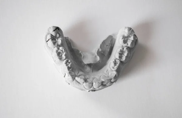Χύτευση Οδοντωτών Γύψων Από Δόντια Για Την Κατασκευή Ορθοδοντικών Συσκευών — Φωτογραφία Αρχείου