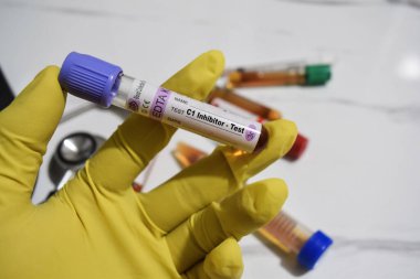 C1 inhibitörü. Kan örneğiyle test edin. Üst görüntü ofis masasında izole edildi. Sağlık ya da Tıp Konsepti
