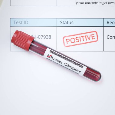 Tıbbi test ve analiz için kan örneğiyle dolu bir tüp. Pozitif sonuç. Hastalık. Ölümcül virüs tespit edildi. HIV, AIDS, Corona, Coronavirus. Hastanedeyiz. Laboratuvar. Mikroskop. Veri koruması