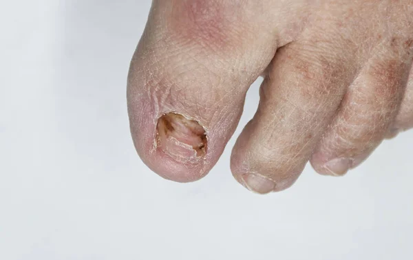 Male Toe Foot Finger Nail Isolated White Background Trauma Nail — Stock Photo, Image