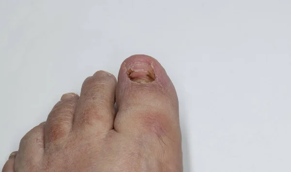 Мужской Палец Ноги Ноги Гвоздя Изолированы Белом Фоне Концепция Потери — стоковое фото