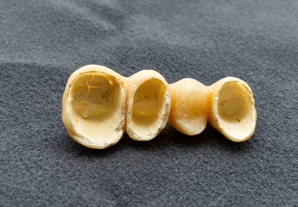 Provizorní Stomatologický Můstek Izolovaný Šedém Pozadí Dočasné Pryskyřičné Zuby Zubní — Stock fotografie