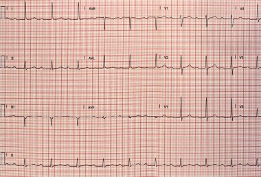 Kağıt şeklinde elektrokardiyogram. Analog elektrokardiyografik kayıt. ECG örneği.