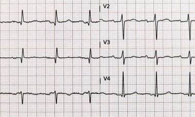 Standart elektrokardiyogram, EKG, grafik kağıdı. Sağlık ve tıbbi kavramlar.