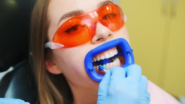 Dentysta Stosuje Detektor Płytki Nazębnej Przednich Zębach Kobiety Okularach Ochronnych — Wideo stockowe