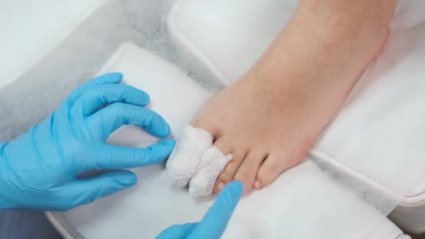 Podolog Używa Bandaża Zastosowaniu Środka Antyseptycznego Palec Nogi Usunięciu Paznokcia — Wideo stockowe