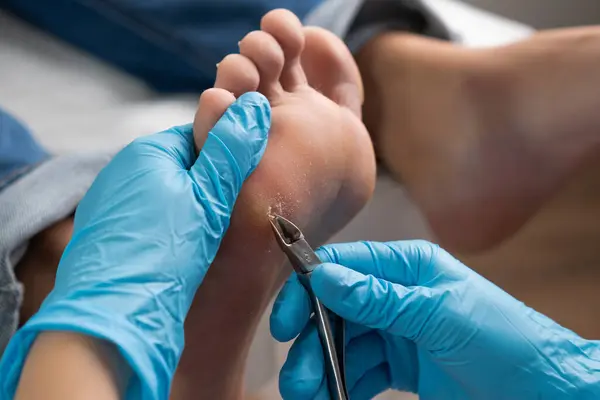 stock image Close up removing a callus on a womans foot by nippers. 