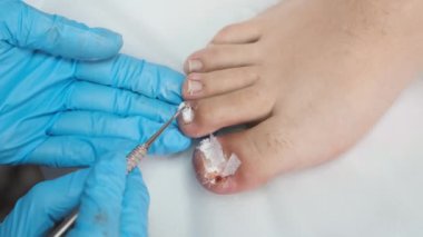Ayak tırnağında mantar enfeksiyonu tedavisi uygulayan ayak hastalıkları uzmanı.. 