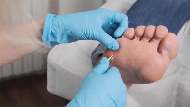 Podiatr Používající Nůžky Odstraní Mozoly Ženské Nohy Lékařském Středisku — Stock video