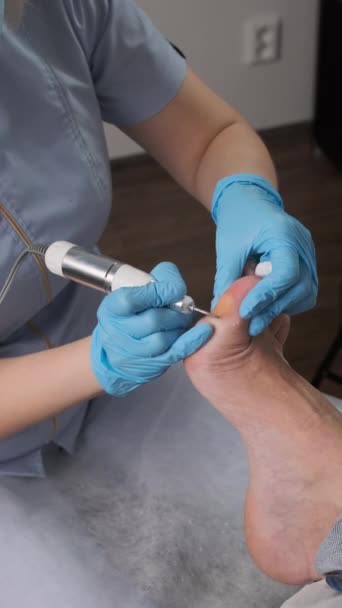 儿科医生用电钻从一个女人的脚上取出一个愈伤组织 — 图库视频影像